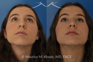 Photo of a patient before and after a procedure. Natural rhinoplasty to smooth a hump narrow and elevate the tip
