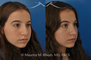 Photo of a patient before and after a procedure. Natural rhinoplasty to smooth a hump narrow and elevate the tip