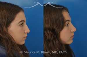 Photo of a patient before and after a procedure. Natural rhinoplasty to smooth a hump narrow and elevate the tip