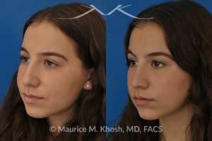 Photo of a patient before and after a procedure. Natural rhinoplasty to smooth a hump narrow and elevate the tip