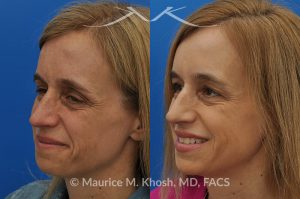 Photo of a patient before and after a procedure. Osteoma of the left forehead