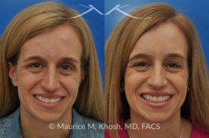 Photo of a patient before and after a procedure. Osteoma of the left forehead