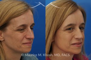 Photo of a patient before and after a procedure. Osteoma of the left forehead