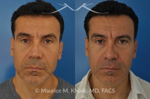 Photo of a patient before and after a procedure. Repair nasal valve obstruction revision rhinoplasty - This gentleman had previously undergone two rhinoplasty operations over 15 years ago. His nasal tip was pinched and obstructing his breathing, Cadaver rib cartilage was used to strengthen and support his external nasal valve. The nasal tip was slightly elevated.