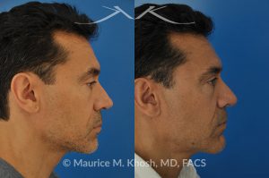 Photo of a patient before and after a procedure. Repair of nasal valve obstruction with revision rhinoplasty - This gentleman had previously undergone two rhinoplasty operations over 15 years ago. His nasal tip was pinched and obstructing his breathing, Cadaver rib cartilage was used to strengthen and support his external nasal valve. The nasal tip was slightly elevated.