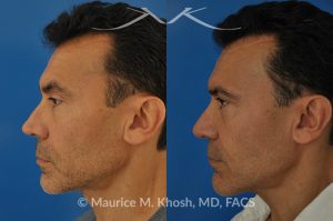 Photo of a patient before and after a procedure. Repair of nasal valve obstruction with revision rhinoplasty - This gentleman had previously undergone two rhinoplasty operations over 15 years ago. His nasal tip was pinched and obstructing his breathing, Cadaver rib cartilage was used to strengthen and support his external nasal valve. The nasal tip was slightly elevated.