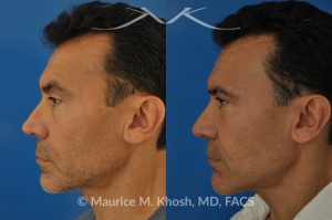 Photo of a patient before and after a procedure. Repair nasal valve obstruction revision rhinoplasty - This gentleman had previously undergone two rhinoplasty operations over 15 years ago. His nasal tip was pinched and obstructing his breathing, Cadaver rib cartilage was used to strengthen and support his external nasal valve. The nasal tip was slightly elevated.