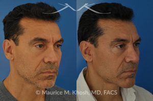 Photo of a patient before and after a procedure. Repair of nasal valve obstruction with revision rhinoplasty - This gentleman had previously undergone two rhinoplasty operations over 15 years ago. His nasal tip was pinched and obstructing his breathing, Cadaver rib cartilage was used to strengthen and support his external nasal valve. The nasal tip was slightly elevated.