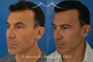 Photo of a patient before and after a procedure. Repair of nasal valve obstruction with revision rhinoplasty - This gentleman had previously undergone two rhinoplasty operations over 15 years ago. His nasal tip was pinched and obstructing his breathing, Cadaver rib cartilage was used to strengthen and support his external nasal valve. The nasal tip was slightly elevated.