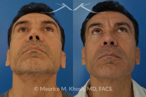 Photo of a patient before and after a procedure. Repair of nasal valve obstruction with revision rhinoplasty - This gentleman had previously undergone two rhinoplasty operations over 15 years ago. His nasal tip was pinched and obstructing his breathing, Cadaver rib cartilage was used to strengthen and support his external nasal valve. The nasal tip was slightly elevated.