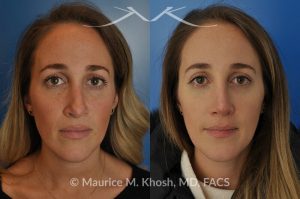 Photo of a patient before and after a procedure. Rhinoplasty to address a bulbous droopy and asymmetric nasal tip