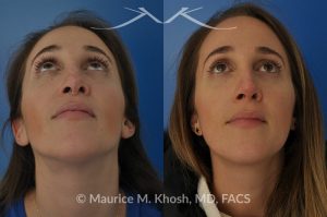 Photo of a patient before and after a procedure. Rhinoplasty to address a bulbous droopy and asymmetric nasal tip