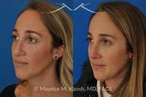 Photo of a patient before and after a procedure. Rhinoplasty to address a bulbous droopy and asymmetric nasal tip