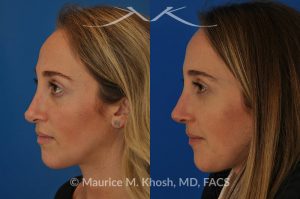 Photo of a patient before and after a procedure. Rhinoplasty to address a bulbous droopy and asymmetric nasal tip