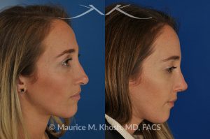 Photo of a patient before and after a procedure. Rhinoplasty to address a bulbous droopy and asymmetric nasal tip