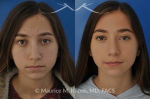 Photo of a patient before and after a procedure. Rhinoplasty for a refined nose with smoth bridge tip elevation and tip narrowing