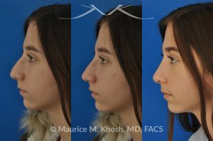 Photo of a patient before and after a procedure. Rhinoplasty for a refined nose with smoth bridge tip elevation and tip narrowing