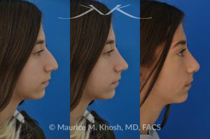 Photo of a patient before and after a procedure. Rhinoplasty for a refined nose with smoth bridge tip elevation and tip narrowing