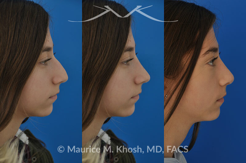 Rhinoplasty for a refined nose with smoth bridge tip elevation and tip narrowing