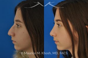 Photo of a patient before and after a procedure. Rhinoplasty for a refined nose with smoth bridge tip elevation and tip narrowing