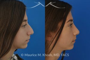 Photo of a patient before and after a procedure. Rhinoplasty for a refined nose with smoth bridge tip elevation and tip narrowing