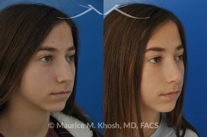 Photo of a patient before and after a procedure. Rhinoplasty for a refined nose with smoth bridge tip elevation and tip narrowing