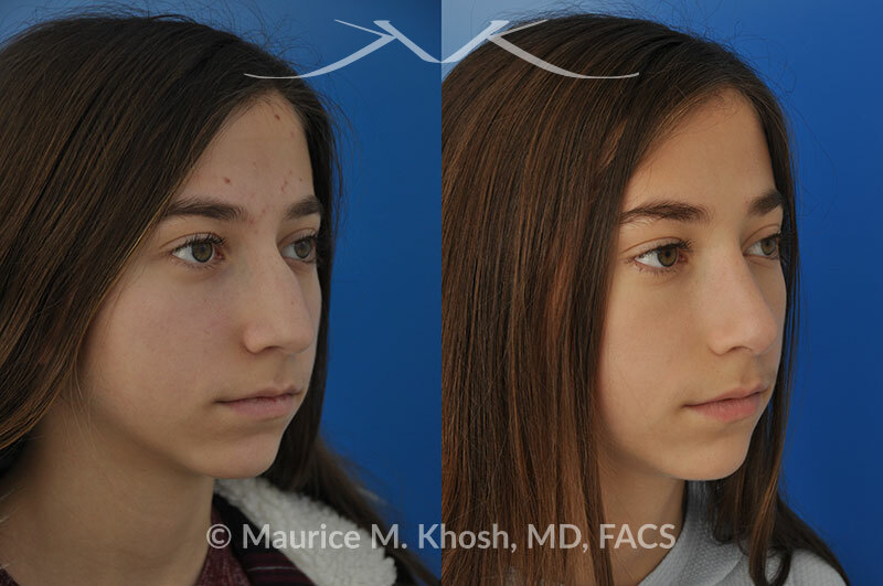 Rhinoplasty for a refined nose with smoth bridge tip elevation and tip narrowing