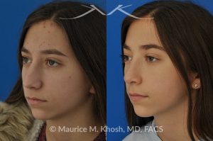 Photo of a patient before and after a procedure. Rhinoplasty for a refined nose with smoth bridge tip elevation and tip narrowing