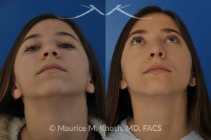 Photo of a patient before and after a procedure. Rhinoplasty for a refined nose with smoth bridge tip elevation and tip narrowing