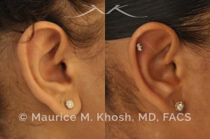 Photo of a patient before and after a procedure. Otoplasty - Earlobe reduction, otoplasty to shorten hanging earlobes