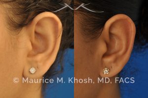 Photo of a patient before and after a procedure. Otoplasty - Earlobe reduction, otoplasty to shorten hanging earlobes