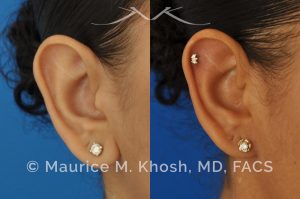 Photo of a patient before and after a procedure. Otoplasty - Earlobe reduction, otoplasty to shorten hanging earlobes