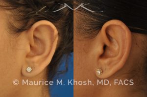 Photo of a patient before and after a procedure. Otoplasty - Earlobe reduction, otoplasty to shorten hanging earlobes