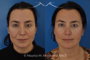 Photo of a patient before and after a procedure. FaceTite Morpheus