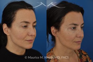 Photo of a patient before and after a procedure. FaceTite Morpheus