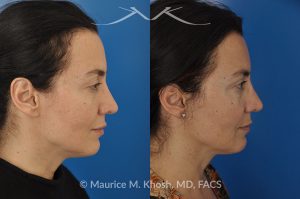 Photo of a patient before and after a procedure. FaceTite Morpheus