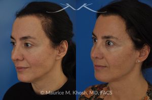 Photo of a patient before and after a procedure. FaceTite Morpheus