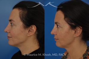 Photo of a patient before and after a procedure. FaceTite Morpheus