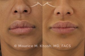 Photo of a patient before and after a procedure. Lip reduction - Lip reduction to improve the swollen appearing upper lip, which was caused by Silocone injection of the lips