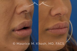 Photo of a patient before and after a procedure. Lip reduction - Lip reduction to improve the swollen appearing upper lip, which was caused by Silocone injection of the lips