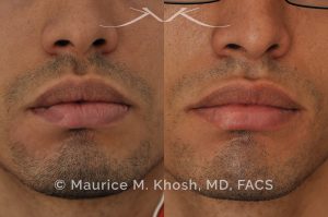 Photo of a patient before and after a procedure. Lip scar revision - Lip scar revision to improve a depressed scar in the right lower lip, near the corner