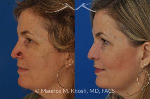 Photo of a patient before and after a procedure. Moh's repair of nose defect after removal of skin cancer. A bilobed flap was used for the repair - before and after photos.