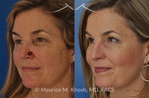 Photo of a patient before and after a procedure. Moh's repair of nose defect after removal of skin cancer. A bilobed flap was used for the repair