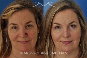 Photo of a patient before and after a procedure. Moh's repair of nose defect after removal of skin cancer. A bilobed flap was used for the repair - before and after photos.