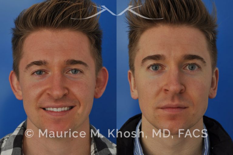 New York Ear Pinning, Otoplasty Maurice M. Khosh MD, FACS