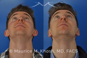 Photo of a patient before and after a procedure. Otoplasty - Ear pinning to push back excessively projected ears and flatten ears