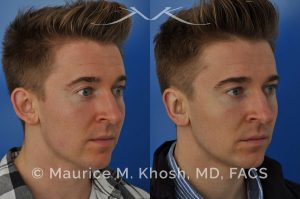 Photo of a patient before and after a procedure. Otoplasty - Ear pinning to push back excessively projected ears and flatten ears