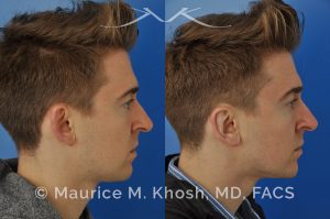 Photo of a patient before and after a procedure. Otoplasty - Ear pinning to push back excessively projected ears and flatten ears