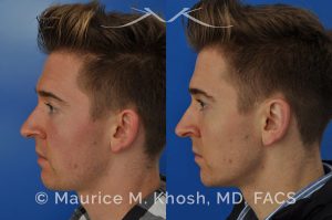 Photo of a patient before and after a procedure. Otoplasty - Ear pinning to push back excessively projected ears and flatten ears