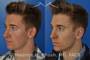 Photo of a patient before and after a procedure. Otoplasty - Ear pinning to push back excessively projected ears and flatten ears